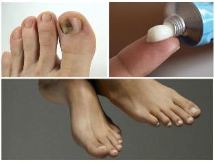 Nail fungus ointments on the feet