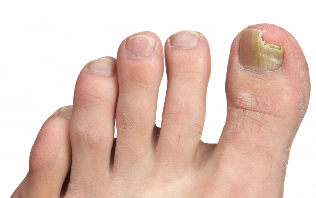 Nail fungus on the feet stage