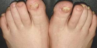 what is the nail fungus is