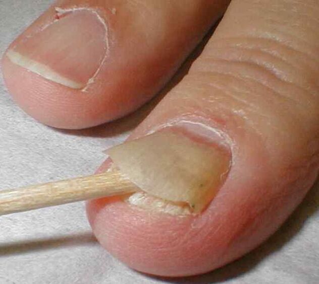 Nail peeling with toenail fungus