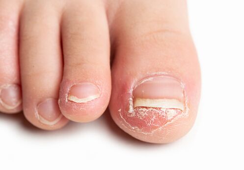 What does a toenail fungus look like