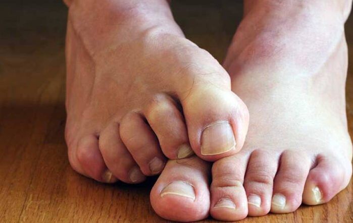 Symptoms of squamous epithelium on the feet