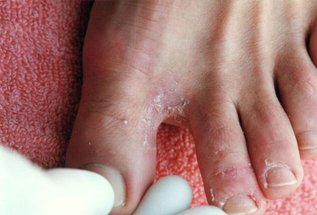 Symptoms of a fungus between the toes