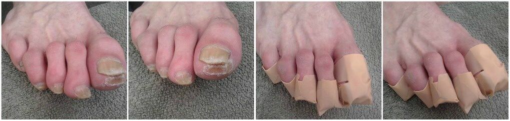Applying plasters against toenail fungus