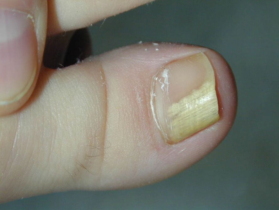 Fungal symptom - discoloration of the nail