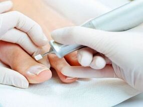 Therapeutic pedicure against toenail fungus
