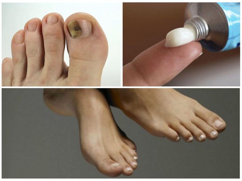 Treatment with ointments