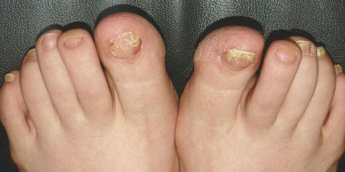Onychomycosis of the nails on the legs