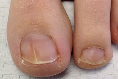 Fingernail fungus