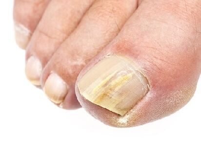 What does nail funga look like