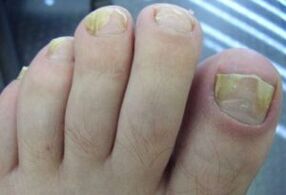 Affected by the nail with fungal infections