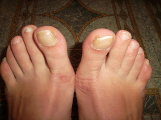 Fungus of the great toe