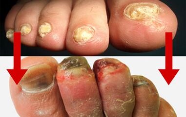 Manifestations of the mushroom to the fingers