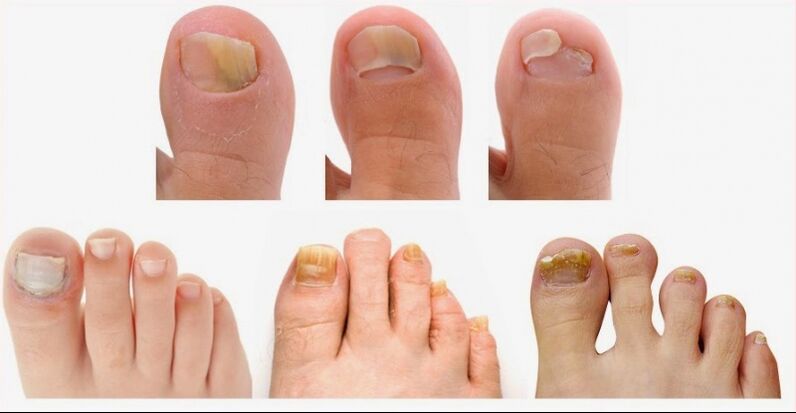 The first signs of onychomycosis