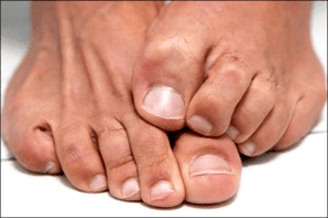 Itching of the skin of the feet due to a fungal nail infection
