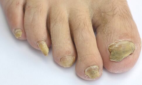 Causes and symptoms of fungus on toenails