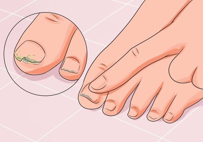 How to treat toenail fungus with drops