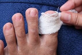 Compress against nail fungus