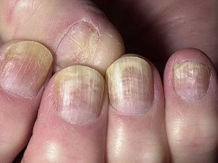 the fungus on the nails