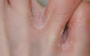 Fungus of the skin on the legs